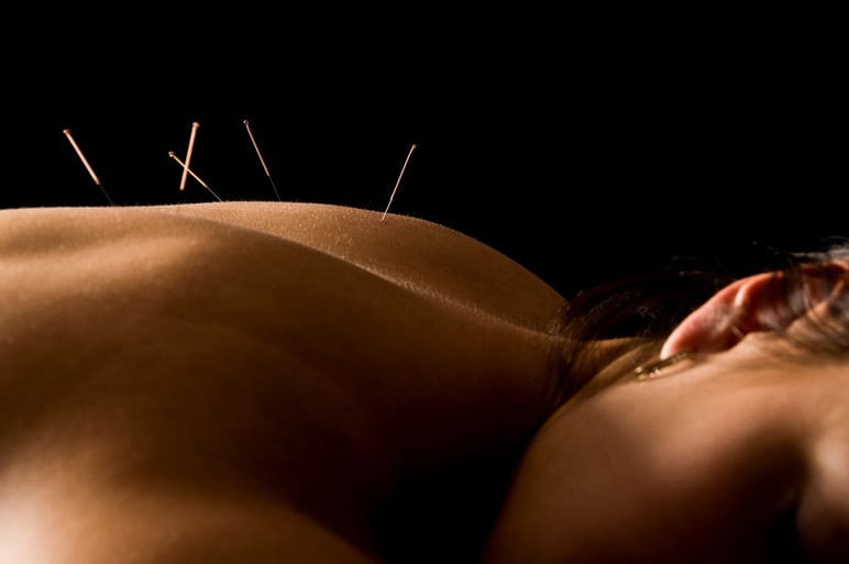 What Can Acupuncture Treat?