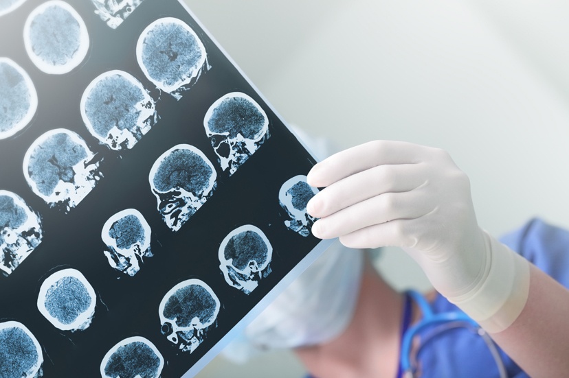 What is a Brain Injury?